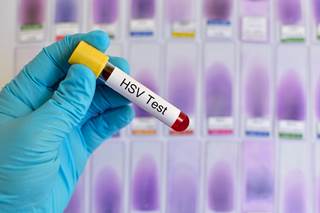 Testing is not generally helpful for people without symptoms of HSV infection. Testing is not generally helpful for people without symptoms of HSV infection.