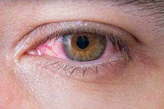 <i>Kingella kingae</i> causes microbial keratitis in a 52-year-old patient with HIV. <i>Kingella kingae</i> causes microbial keratitis in a 52-year-old patient with HIV.