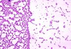 Oral Bacteria Tied to Cerebral Microbleeds Point to Stroke Risk Oral Bacteria Tied to Cerebral Microbleeds Point to Stroke Risk