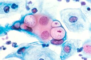Human pap smear showing chlamydia in the vacuoles. <i>Photo Credit: Dr Lance Liotta Laboratory via Wikimedia Commons. </i> Human pap smear showing chlamydia in the vacuoles. <i>Photo Credit: Dr Lance Liotta Laboratory via Wikimedia Commons. </i>