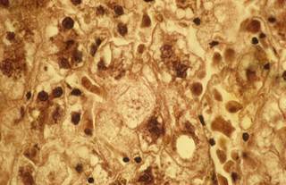Sustained virologic response seen for newer combinations of HCV genotype 1b antivirals. <i>Photo Credit: Prof. François Potet / CNRI / Science Source.</i> Sustained virologic response seen for newer combinations of HCV genotype 1b antivirals. <i>Photo Credit: Prof. François Potet / CNRI / Science Source.</i>