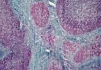Glycemic Control Improves With Hepatitis C Treatment Glycemic Control Improves With Hepatitis C Treatment