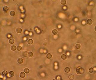 Multiple white cells seen in the urine of a person with a urinary tract infection. <i>Photo Credit: By Bobjgalindo (Own work), via Wikimedia Commons.</i> Multiple white cells seen in the urine of a person with a urinary tract infection. <i>Photo Credit: By Bobjgalindo (Own work), via Wikimedia Commons.</i>
