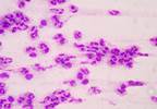 Sepsis Calculator Reduces Antibiotic Therapy for Suspected Early-Onset Sepsis Sepsis Calculator Reduces Antibiotic Therapy for Suspected Early-Onset Sepsis