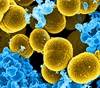 <i>Staphylococcus aureus</i> in Patients Diagnosed With Bronchiectasis Without Cystic Fibrosis <i>Staphylococcus aureus</i> in Patients Diagnosed With Bronchiectasis Without Cystic Fibrosis