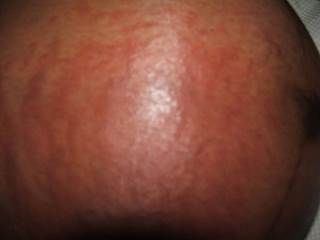 Abdomen with pruritic urticarial papules and plaques of pregnancy. <i>Photo Credit: Fiji350 at English Wikipedia, via Wikimedia Commons.</i> Abdomen with pruritic urticarial papules and plaques of pregnancy. <i>Photo Credit: Fiji350 at English Wikipedia, via Wikimedia Commons.</i>