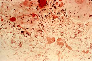Gram-stained micrograph of a rectal smear specimen reveals the presence of diplococcal <i>N gonorrhoeae</i> bacteria. <i>Photo Credit: CDC/ Joe Miller.</i> Gram-stained micrograph of a rectal smear specimen reveals the presence of diplococcal <i>N gonorrhoeae</i> bacteria. <i>Photo Credit: CDC/ Joe Miller.</i>