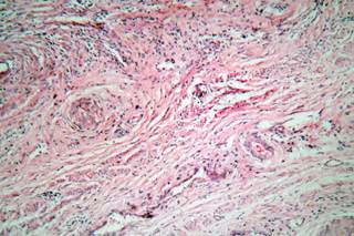 Presence of HPV infection in women with SLE statistically significant in a 3-year follow-up study. Presence of HPV infection in women with SLE statistically significant in a 3-year follow-up study.