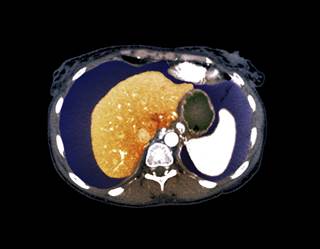 Development of type 2 diabetes was also associated with a further increased risk of developing severe liver disease. Development of type 2 diabetes was also associated with a further increased risk of developing severe liver disease.