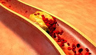 Chronic hepatitis B virus infection may actually lower the risk for developing dyslipidemia. Chronic hepatitis B virus infection may actually lower the risk for developing dyslipidemia.