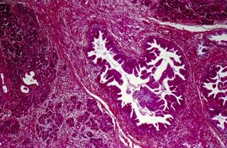 In the elderly population, hepatitis C virus infection is associated with cancers other than hepatocellular carcinoma. <i>Photo Credit: CNRI/Science Source.</i> In the elderly population, hepatitis C virus infection is associated with cancers other than hepatocellular carcinoma. <i>Photo Credit: CNRI/Science Source.</i>