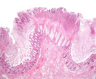 38% of recurrent <i>C difficile</i> infections were prevented with bezlotoxumab. <i>Photo Credit: By Nephron (Own work), via Wikimedia Commons.</i> 38% of recurrent <i>C difficile</i> infections were prevented with bezlotoxumab. <i>Photo Credit: By Nephron (Own work), via Wikimedia Commons.</i>