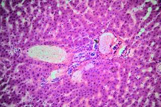 Further investigation needed to understand the reasons for the cases of liver failure and antiviral failure reported to the FDA. Further investigation needed to understand the reasons for the cases of liver failure and antiviral failure reported to the FDA.