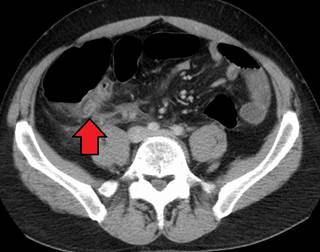 Use of antibiotics alone for cases of uncomplicated appendicitis safe in children. <i>Photo Credit: By James Heilman, MD (Own work), via Wikimedia Commons.</i> Use of antibiotics alone for cases of uncomplicated appendicitis safe in children. <i>Photo Credit: By James Heilman, MD (Own work), via Wikimedia Commons.</i>