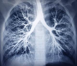 Endobronchial suture should be considered in patients with recurrent pneumonia that is unresponsive to medical therapy. Endobronchial suture should be considered in patients with recurrent pneumonia that is unresponsive to medical therapy.