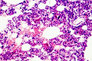 The cysteinyl leukotriene pathway may be a therapeutic target in future research preventing morbidity associated with severe IAV infection. The cysteinyl leukotriene pathway may be a therapeutic target in future research preventing morbidity associated with severe IAV infection.