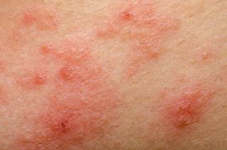 Intramuscular rather than intradermal flu vaccination is preferred in patients with <i>S aureus</i> colonized atopic dermatitis. Intramuscular rather than intradermal flu vaccination is preferred in patients with <i>S aureus</i> colonized atopic dermatitis.