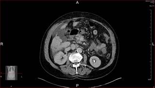 Hepatocellular carcinoma after SVR has not increased with the widespread use of all oral direct antivirals. <i>Photo Credit: Dr P. Marazzi/Science Source.</i> Hepatocellular carcinoma after SVR has not increased with the widespread use of all oral direct antivirals. <i>Photo Credit: Dr P. Marazzi/Science Source.</i>