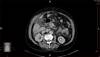 Liver Cancer Rates With Interferon-Free Regimens in HIV/HCV Liver Cancer Rates With Interferon-Free Regimens in HIV/HCV