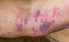 Risk of Herpes Zoster Increased With TNFi Treatment in RA Patients Risk of Herpes Zoster Increased With TNFi Treatment in RA Patients