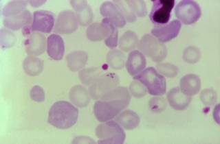 Researchers find 6 patients with asplenia developed WAHA weeks after babesiosis diagnosis. <i>Photo Credit: CDC/Dr Mae Melvin.</i> Researchers find 6 patients with asplenia developed WAHA weeks after babesiosis diagnosis. <i>Photo Credit: CDC/Dr Mae Melvin.</i>