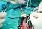 Pacemaker Increases Infective Endocarditis Risk in Aortic Valve Replacement Pacemaker Increases Infective Endocarditis Risk in Aortic Valve Replacement