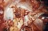 How Many Chances Are Too Many? Treating Recurrent Infective Endocarditis in IV Drug Users How Many Chances Are Too Many? Treating Recurrent Infective Endocarditis in IV Drug Users