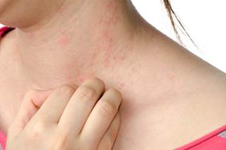Dr Francis and colleagues treated 113 patients with a mix of topical emollient and corticosteroids. Dr Francis and colleagues treated 113 patients with a mix of topical emollient and corticosteroids.