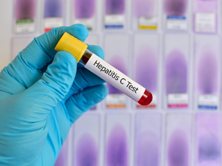 HCV testing among baby boomers did not substantially increase and remains low 2 years after the USPSTF recommendation in 2013. HCV testing among baby boomers did not substantially increase and remains low 2 years after the USPSTF recommendation in 2013.