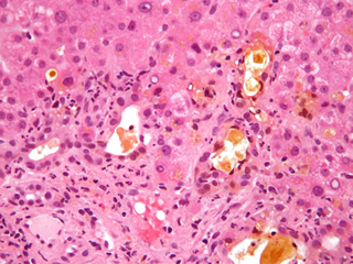 ACG reviewed studies from MEDLINE and EMBASE regarding the evaluation of abnormal liver chemistries. <i>Photo Credit: By Nephron (Own work), via Wikimedia Commons.</i> ACG reviewed studies from MEDLINE and EMBASE regarding the evaluation of abnormal liver chemistries. <i>Photo Credit: By Nephron (Own work), via Wikimedia Commons.</i>