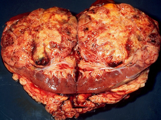 First analysis evaluating the impact of broad-spectrum antibiotics in mRCC patients treated in the era of immune checkpoint inhibitors. <i>Photo Credit: CDC/Dr Edwin P. Ewing, Jr.</i> First analysis evaluating the impact of broad-spectrum antibiotics in mRCC patients treated in the era of immune checkpoint inhibitors. <i>Photo Credit: CDC/Dr Edwin P. Ewing, Jr.</i>