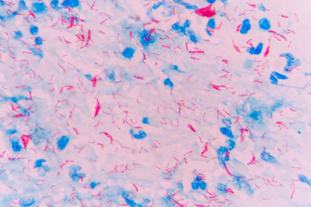 Naked eye detection of the Mycobacterium tuberculosis 