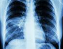 Fluoroquinolones May Aid in Reducing Mortality in Community-Acquired Pneumonia Fluoroquinolones May Aid in Reducing Mortality in Community-Acquired Pneumonia