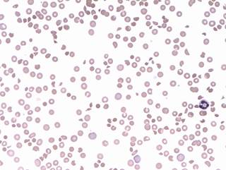 Prophylactic platelet transfusion is often used to prevent bleeding in dengue and thrombocytopenia. <i>Photo Credit: Erhabor Osaro (Associate Professor) (Own work), via Wikimedia Commons. </i> Prophylactic platelet transfusion is often used to prevent bleeding in dengue and thrombocytopenia. <i>Photo Credit: Erhabor Osaro (Associate Professor) (Own work), via Wikimedia Commons. </i>