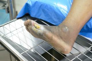 Gram-negative bacteria prevailed at 69.5% in patients with infected diabetic foot ulcer. Gram-negative bacteria prevailed at 69.5% in patients with infected diabetic foot ulcer.