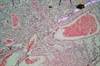 Women With HIV Have Higher Cervical Cancer Progression Women With HIV Have Higher Cervical Cancer Progression