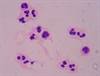 Molecular Laboratory Test Can Discriminate Sepsis From Noninfectious SIRS Molecular Laboratory Test Can Discriminate Sepsis From Noninfectious SIRS