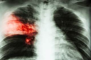 The risk for pneumonia was slightly higher in recent benzodiazepine users compared with former users. The risk for pneumonia was slightly higher in recent benzodiazepine users compared with former users.