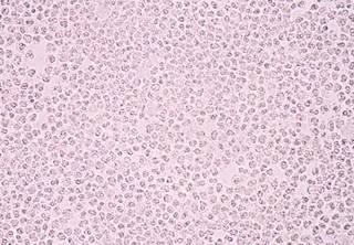 The ZEUS study showed that Zolyd was statistically non-inferior to piperacillin/tazobactam. The ZEUS study showed that Zolyd was statistically non-inferior to piperacillin/tazobactam.