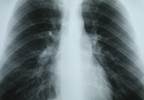 Benzodiazepine Use Increases Pneumonia Risk in Alzheimer Disease Benzodiazepine Use Increases Pneumonia Risk in Alzheimer Disease