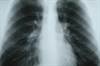 Pneumonia and Influenza May Trigger Acute MI, Stroke Pneumonia and Influenza May Trigger Acute MI, Stroke