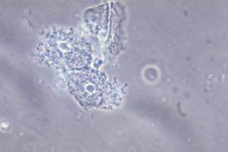 Solosec may be co-administered with combination oral contraceptives as no clinically significant drug interaction was seen. <i>Photo Credit: CDC/M Rein.</i> Solosec may be co-administered with combination oral contraceptives as no clinically significant drug interaction was seen. <i>Photo Credit: CDC/M Rein.</i>