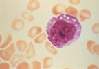 Higher Risk of Hantavirus Pulmonary Syndrome in Certain Populations Higher Risk of Hantavirus Pulmonary Syndrome in Certain Populations