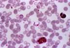 AHA Issues Scientific Statement on Managing Chagas Cardiomyopathy AHA Issues Scientific Statement on Managing Chagas Cardiomyopathy