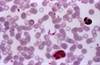 FDA Grants Accelerated Approval for First US Chagas Disease Treatment FDA Grants Accelerated Approval for First US Chagas Disease Treatment
