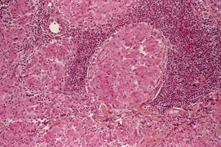 Investigators assert that their trial adds to the mounting evidence of benefits of rifamycin-containing regimens of 3 or 4 months’ duration. Investigators assert that their trial adds to the mounting evidence of benefits of rifamycin-containing regimens of 3 or 4 months’ duration.
