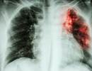 Higher Rate of Osteoporosis, Osteoporotic Fracture in Patients With Tuberculosis Higher Rate of Osteoporosis, Osteoporotic Fracture in Patients With Tuberculosis