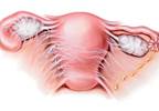Initial Treatment for Chlamydia Improves Pelvic Inflammatory Disease Outcomes Initial Treatment for Chlamydia Improves Pelvic Inflammatory Disease Outcomes
