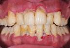Periodontal Disease and Rheumatoid Arthritis: What Are the Links? Periodontal Disease and Rheumatoid Arthritis: What Are the Links?