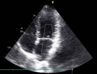 Researchers evaluated the prognostic importance of DSPE in adult patients undergoing isolated liver transplantation. <i>Photo Credit: Chris Gallagher/Science Source</i> Researchers evaluated the prognostic importance of DSPE in adult patients undergoing isolated liver transplantation. <i>Photo Credit: Chris Gallagher/Science Source</i>